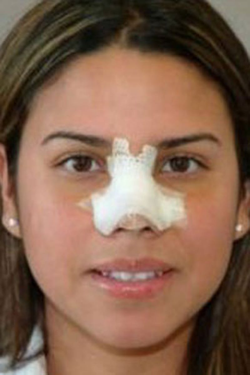 Rhinoplasty Before & After Gallery - Patient 250311 - Image 1