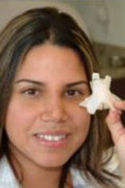 Rhinoplasty Before & After Gallery - Patient 250311 - Image 2