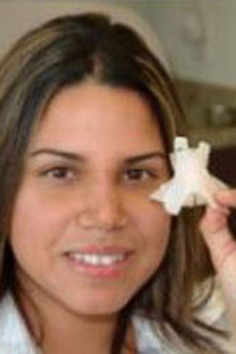 Rhinoplasty Before & After Gallery - Patient 250311 - Image 2