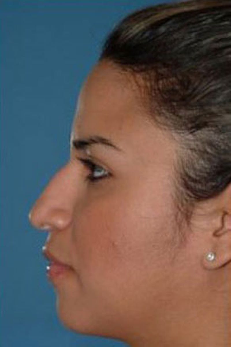 Rhinoplasty Before & After Gallery - Patient 242895 - Image 1