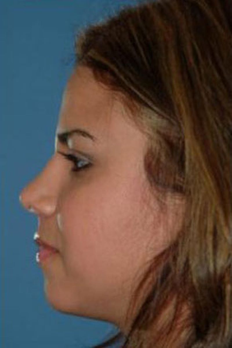 Rhinoplasty Before & After Gallery - Patient 242895 - Image 2
