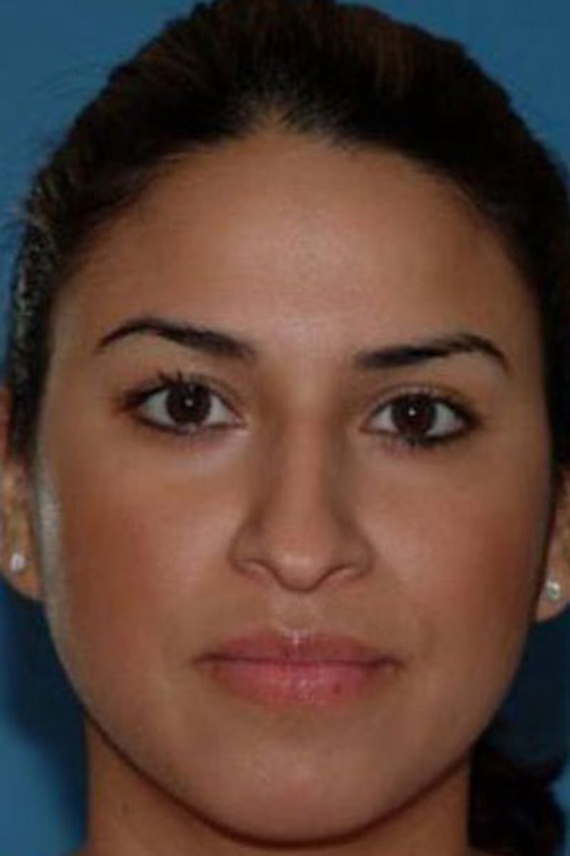 Rhinoplasty Before & After Gallery - Patient 242895 - Image 3