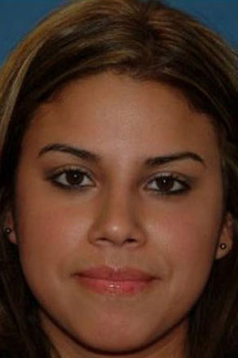 Rhinoplasty Before & After Gallery - Patient 242895 - Image 4