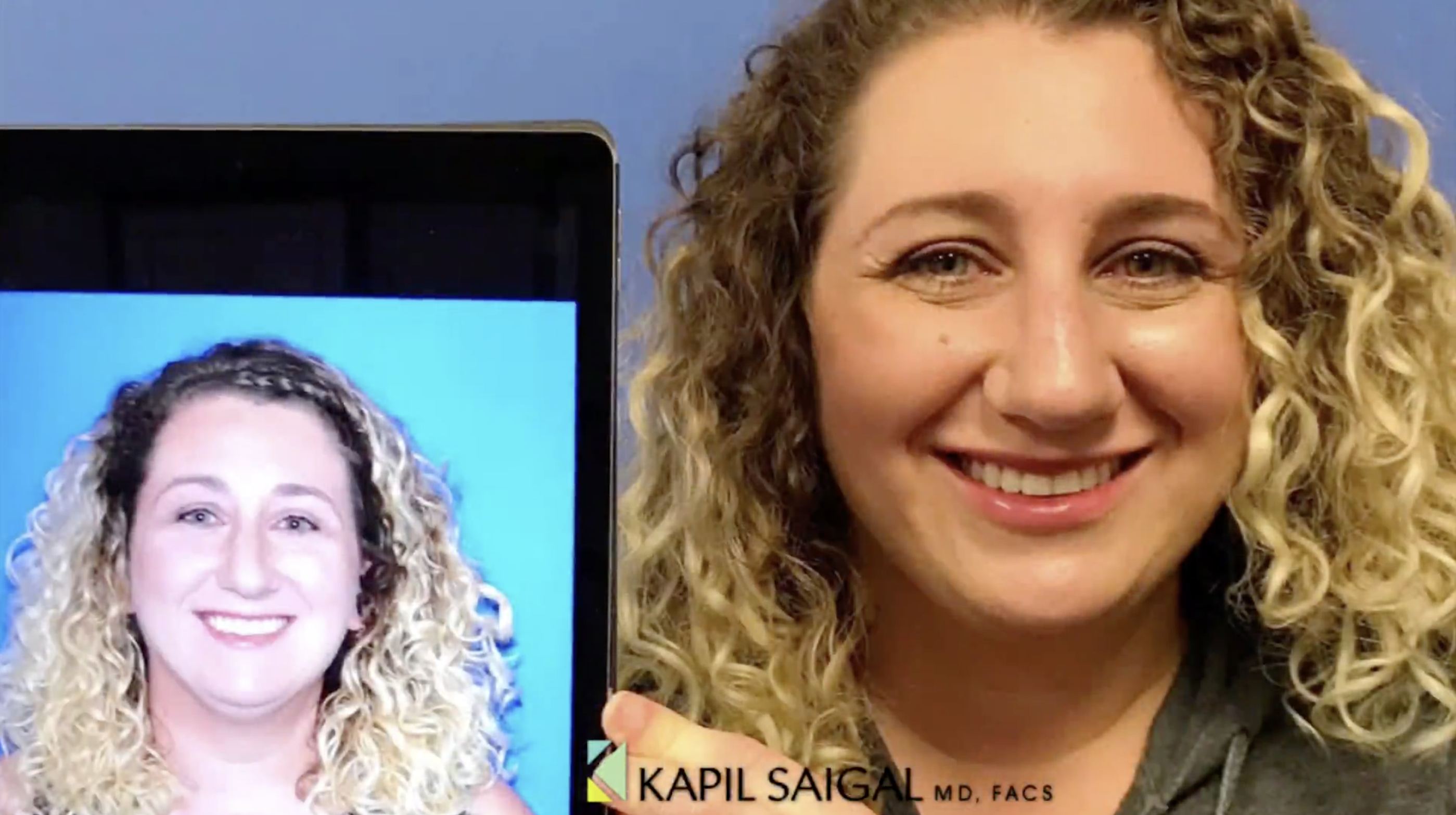 before and after neck liposuction