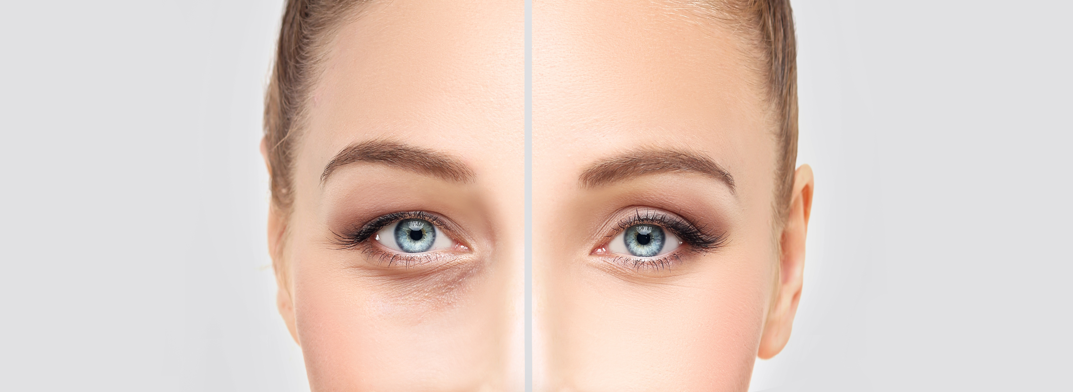 Blepharoplasty