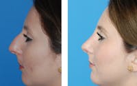 Rhinoplasty Before & After Gallery - Patient 1789781 - Image 1