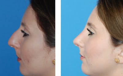 Rhinoplasty Before & After Gallery - Patient 1789781 - Image 1