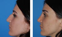 Rhinoplasty Before & After Gallery - Patient 1789782 - Image 1