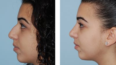 Rhinoplasty Before & After Gallery - Patient 1789783 - Image 1