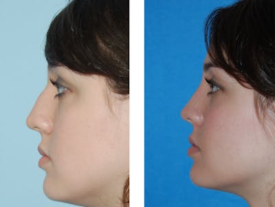 Rhinoplasty Before & After Gallery - Patient 1789785 - Image 1