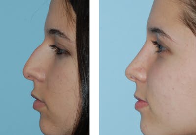 Rhinoplasty Before & After Gallery - Patient 1789786 - Image 1