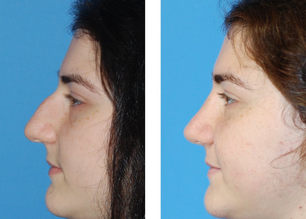 Rhinoplasty Before & After Gallery - Patient 1789788 - Image 1