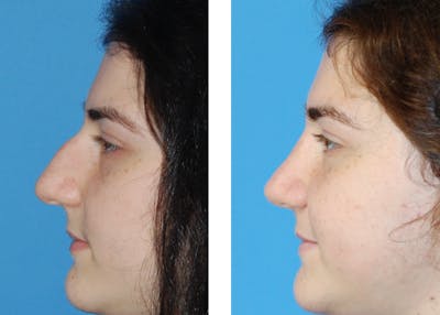Rhinoplasty Before & After Gallery - Patient 1789788 - Image 1