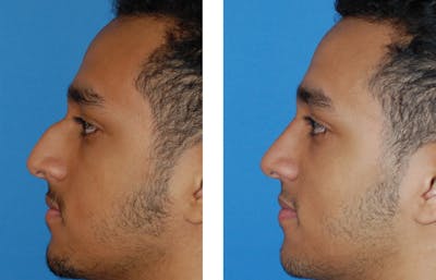 Rhinoplasty Before & After Gallery - Patient 1789789 - Image 1