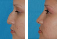 Rhinoplasty Before & After Gallery - Patient 1789792 - Image 1