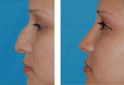 Rhinoplasty Before & After Gallery - Patient 1789792 - Image 1