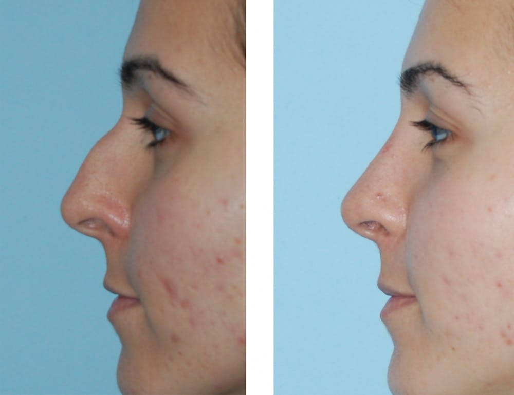 Rhinoplasty Before & After Gallery - Patient 1789803 - Image 1