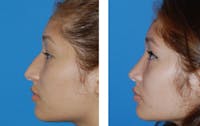 Rhinoplasty Before & After Gallery - Patient 1789805 - Image 1