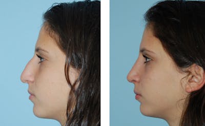 Rhinoplasty Before & After Gallery - Patient 1789927 - Image 1
