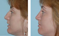 Rhinoplasty Before & After Gallery - Patient 1789928 - Image 1