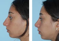 rhinoplasty before and after