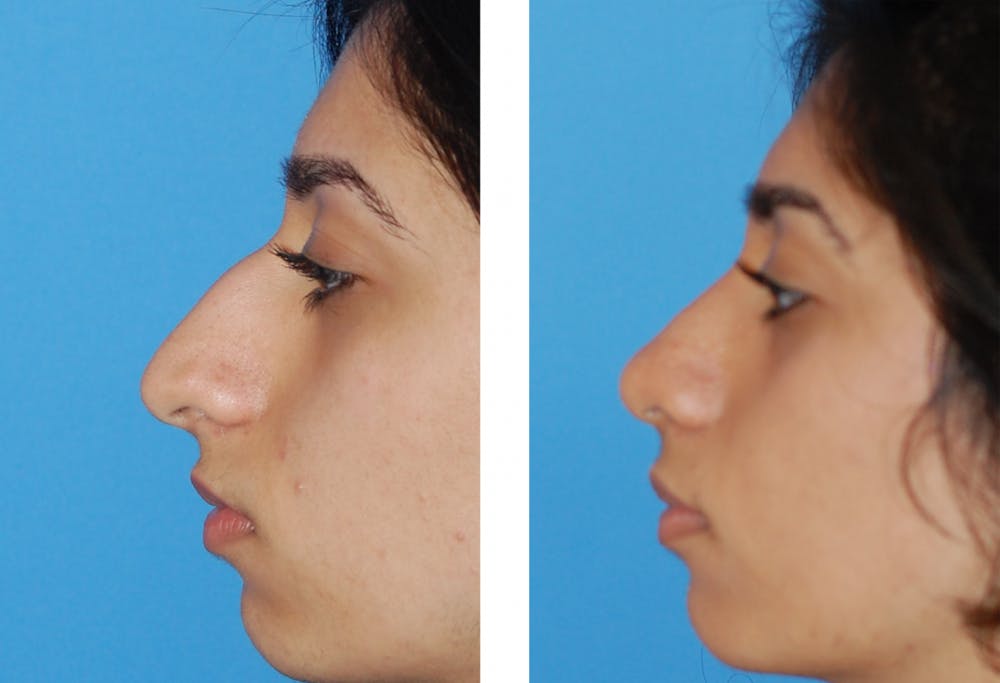 rhinoplasty before and after