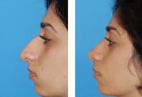 rhinoplasty before and after