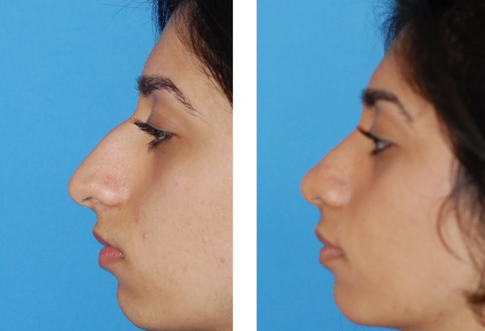 Rhinoplasty Before & After Gallery - Patient 1789931 - Image 1