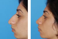 Rhinoplasty Before & After Gallery - Patient 1789931 - Image 1