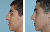 Rhinoplasty Before & After Gallery - Patient 1789932 - Image 1