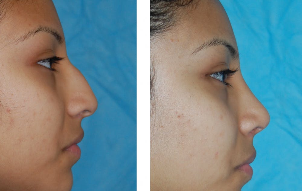 Rhinoplasty Before & After Gallery - Patient 1789933 - Image 1