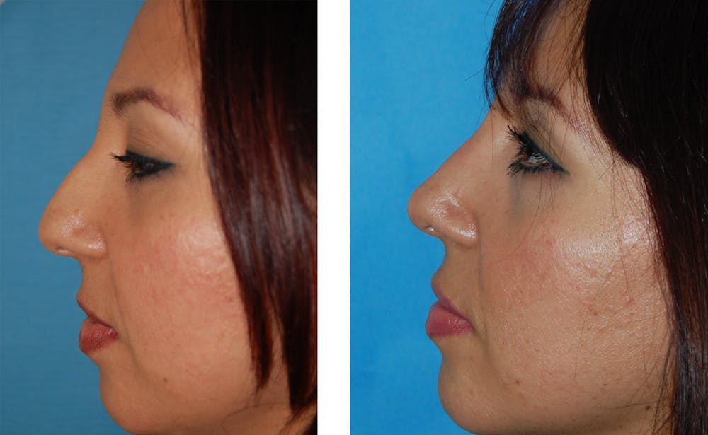 Rhinoplasty Before & After Gallery - Patient 1789934 - Image 1