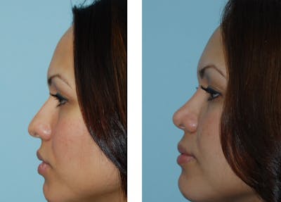 Rhinoplasty Before & After Gallery - Patient 1789935 - Image 1