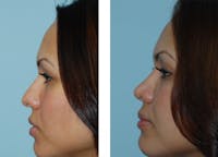Rhinoplasty Before & After Gallery - Patient 1789935 - Image 1