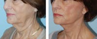 Facelift & Neck Lift Before & After Gallery - Patient 1790078 - Image 1