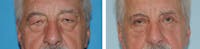 Eyelid Surgery Before & After Gallery - Patient 1790270 - Image 1