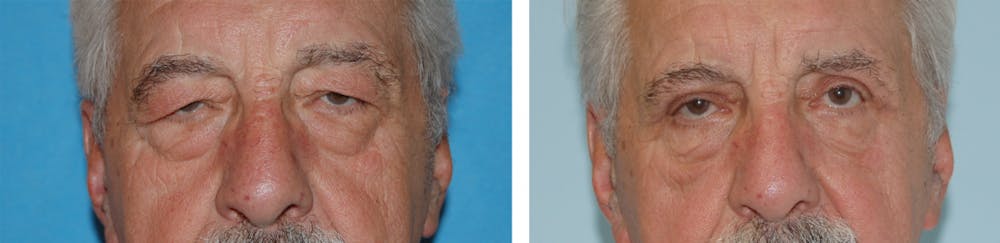 Eyelid Surgery Before & After Gallery - Patient 1790270 - Image 1