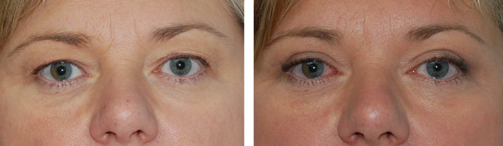 Before and after blepharoplasty in Orlando & Winter Park, FL