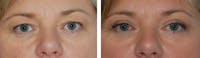 Before and after blepharoplasty in Orlando & Winter Park, FL