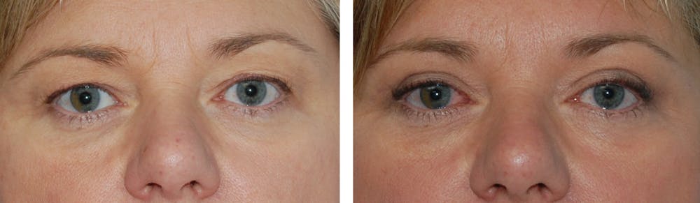 Eyelid Surgery Before & After Gallery - Patient 1790271 - Image 1