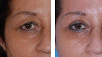 Eyelid Surgery Gallery - Patient 1790273 - Image 1