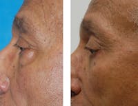 Eyelid Surgery Before & After Gallery - Patient 1790272 - Image 1