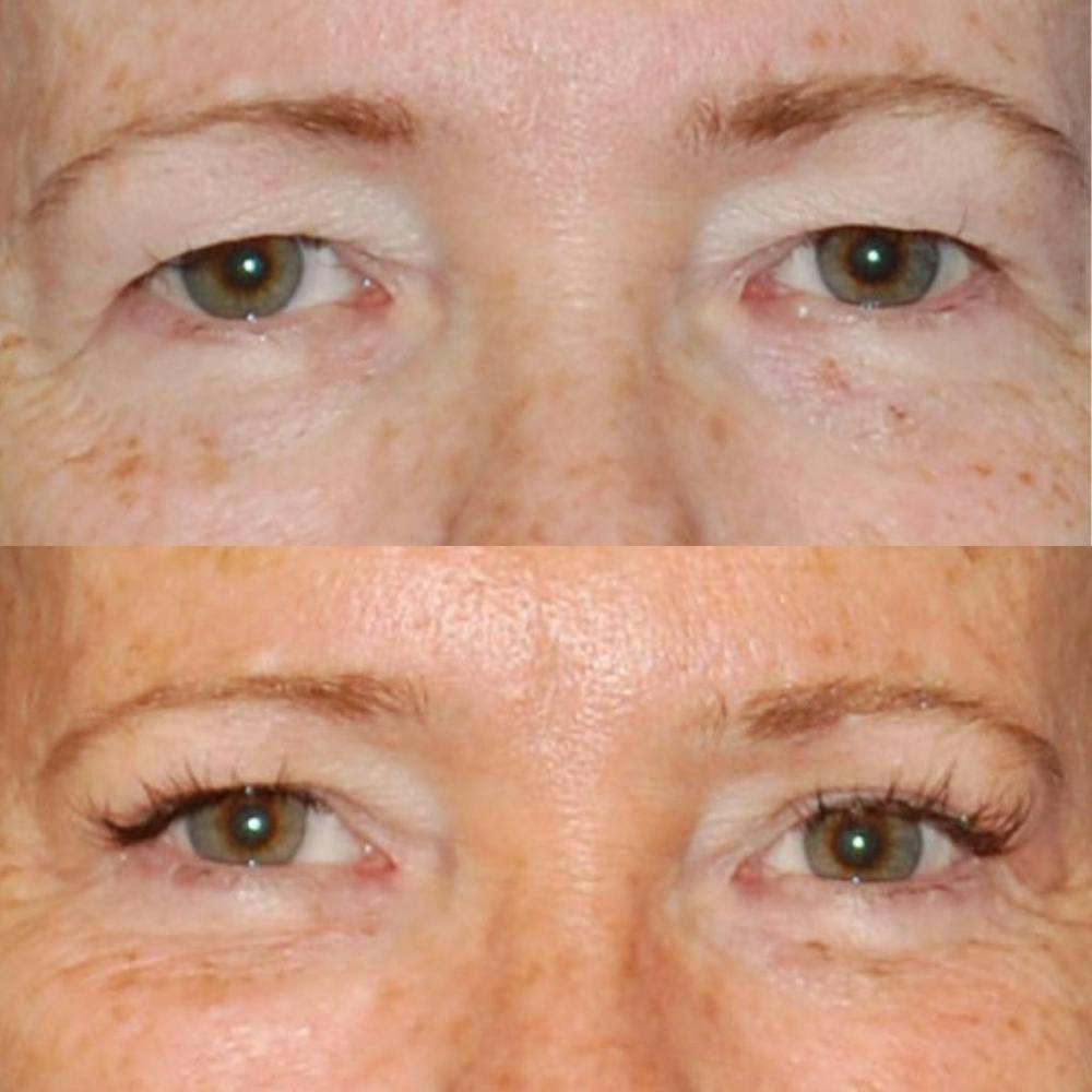 Eyelid Surgery Before & After Gallery - Patient 1790328 - Image 1