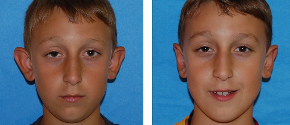 Ear Surgery/Otoplasty Before & After Gallery - Patient 1790330 - Image 1