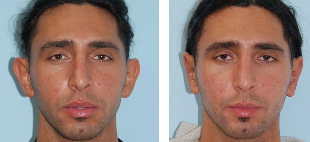Ear Surgery/Otoplasty Before & After Gallery - Patient 1790331 - Image 1