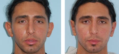 Ear Surgery/Otoplasty Before & After Gallery - Patient 1790331 - Image 1