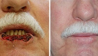 Reconstruction Before & After Gallery - Patient 1790365 - Image 1