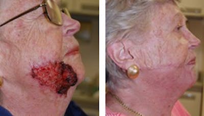 Reconstruction Before & After Gallery - Patient 1790366 - Image 1