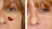 before and after reconstructive surgery