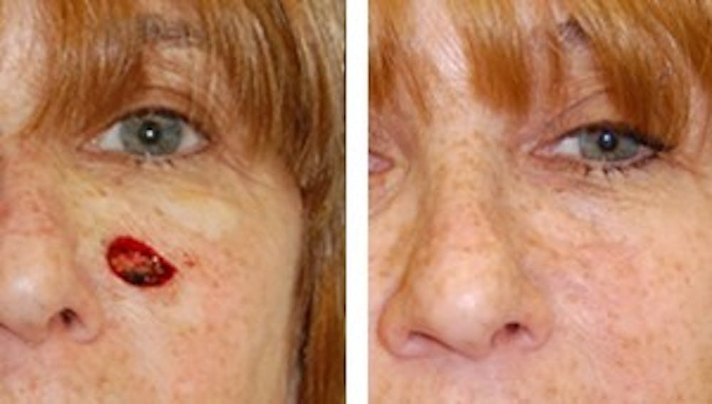 Reconstruction Before & After Gallery - Patient 1790367 - Image 1